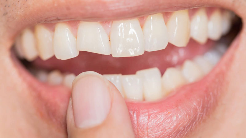 رفع مشکل شکستگی دندان‌ها در طرح لبخند موقت
