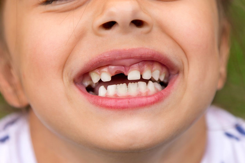 درمان بهم ریختگی دندان اطفال توسط متخصص دندانپزشک