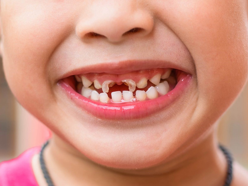 بررسی حد فاصله دندان‌های کودک و کنترل آن برای رشد دندان دائمی