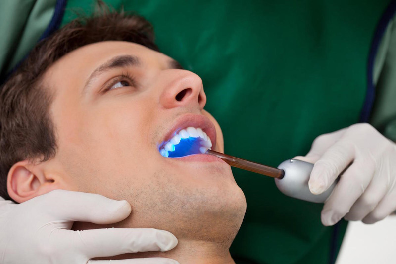 سفت کردن سیلانت به روی دندان بزرگسال به کمک اشعه آبی