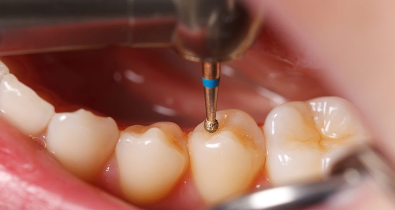اجرای مراحل اصولی فیشور سیلانت دندان اطفال توسط دندانپزشک متخصص