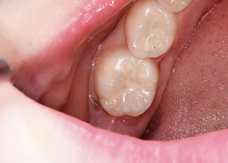 انجام فیشور سیلانت دندان کودکان و نوجوانان برای جلوگیری از پوسیدگی