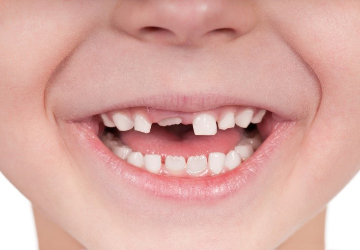 اصلاح روند رشد دندان اطفال به منظور جلوگیری از بهم ریختگی دندان توسط متخصص