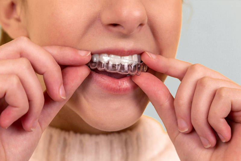 ضرورت طی طول درمان مراحل ارتودنسی دندان‌ها برای اصلاح طرح لبخند