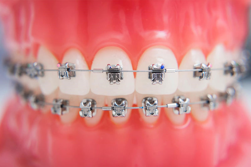 آشنایی با انواع مختلف ارتودنسی دندان و معرفی مراحل ارتودنسی دندان