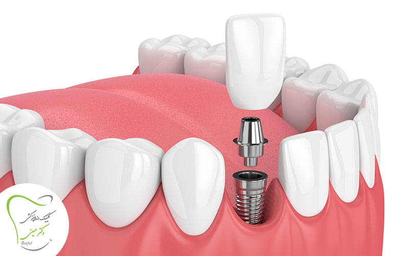ایمپلنت دندان در اسلامشهر