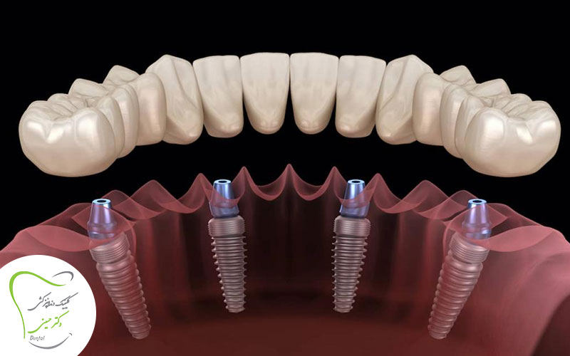 قیمت ایمپلنت دندان در اسلامشهر
