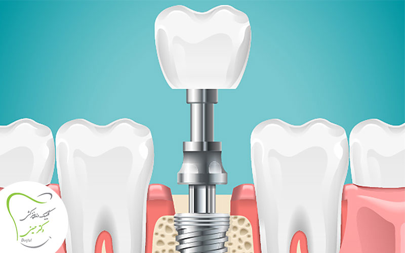 مینی ایمپلنت دندان