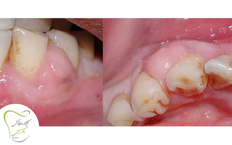 بیماری پریودنتال یا عفونت لثه
